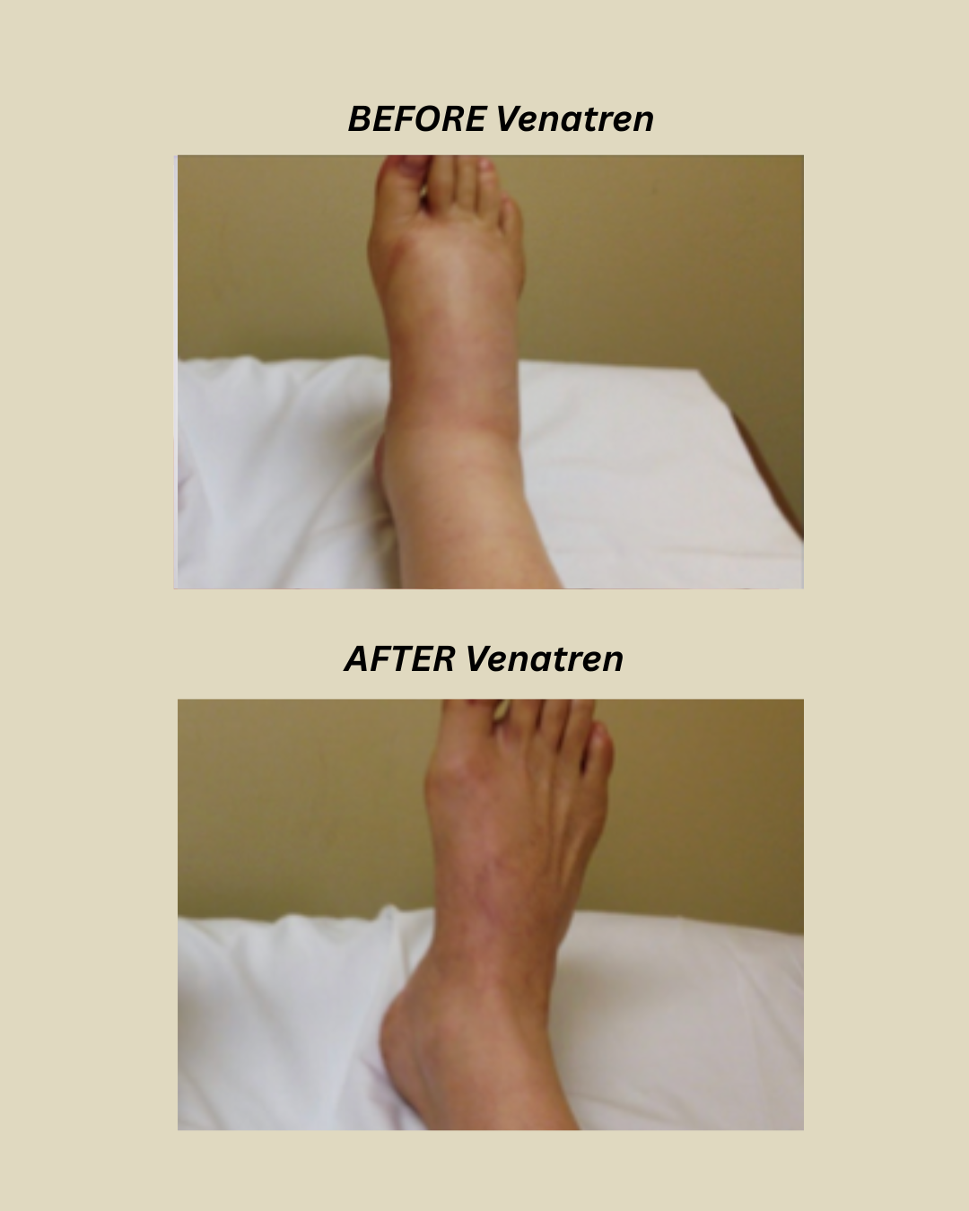 Bee Venom & Turmeric Arthritis Therapy Cream